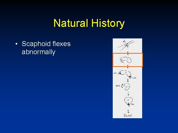 Natural History • Scaphoid flexes abnormally 