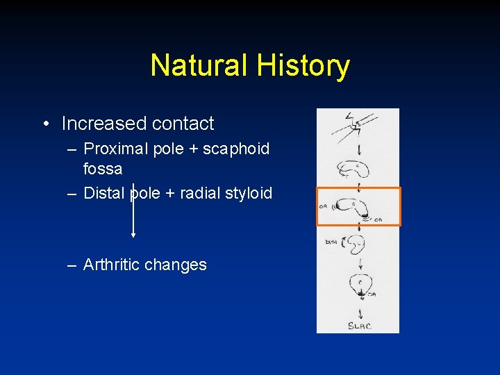 Natural History • Increased contact – Proximal pole + scaphoid fossa – Distal pole