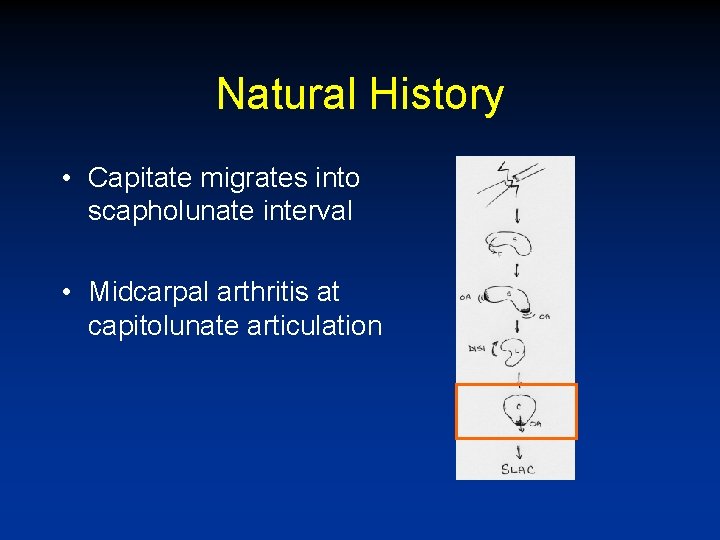 Natural History • Capitate migrates into scapholunate interval • Midcarpal arthritis at capitolunate articulation