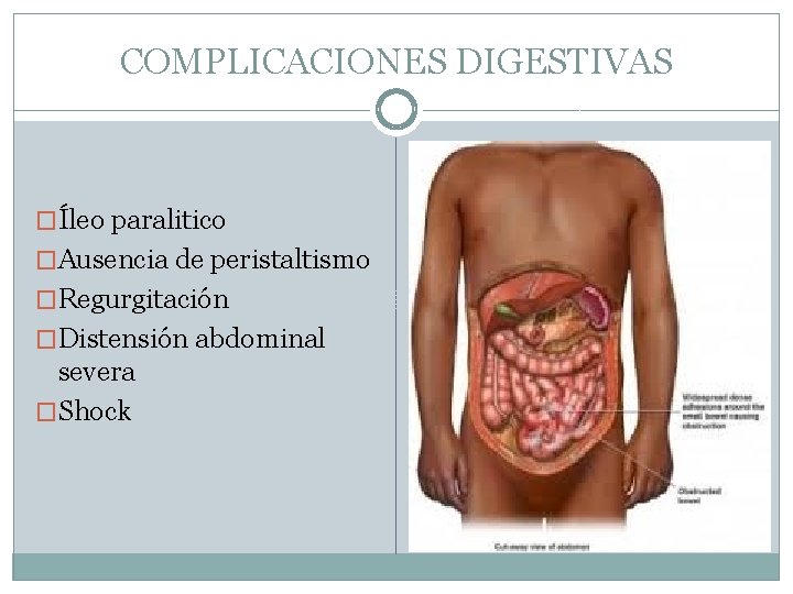 COMPLICACIONES DIGESTIVAS �Íleo paralitico �Ausencia de peristaltismo �Regurgitación �Distensión abdominal severa �Shock 