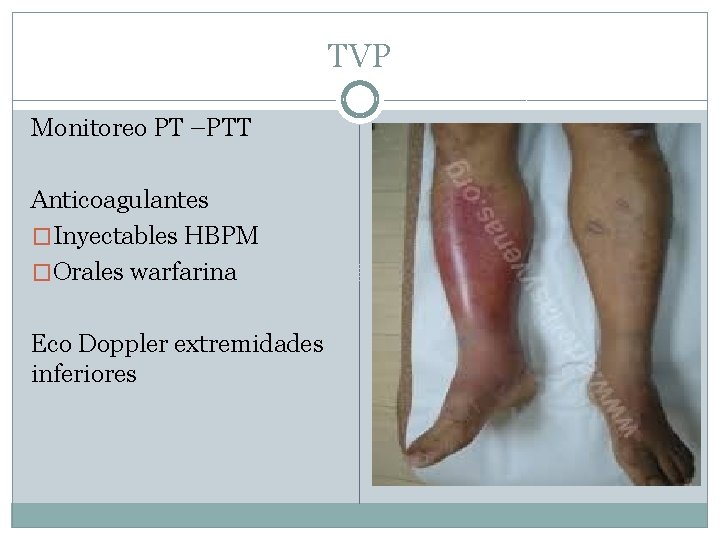 TVP Monitoreo PT –PTT Anticoagulantes �Inyectables HBPM �Orales warfarina Eco Doppler extremidades inferiores 