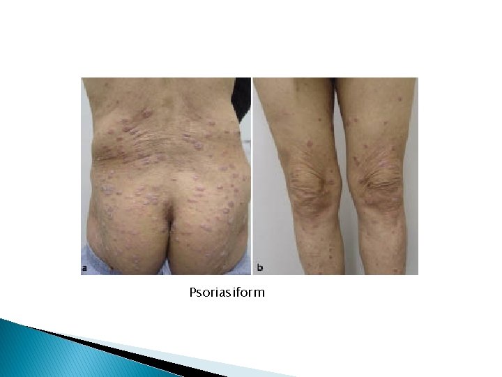 Psoriasiform 