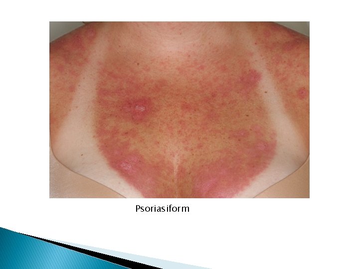 Psoriasiform 