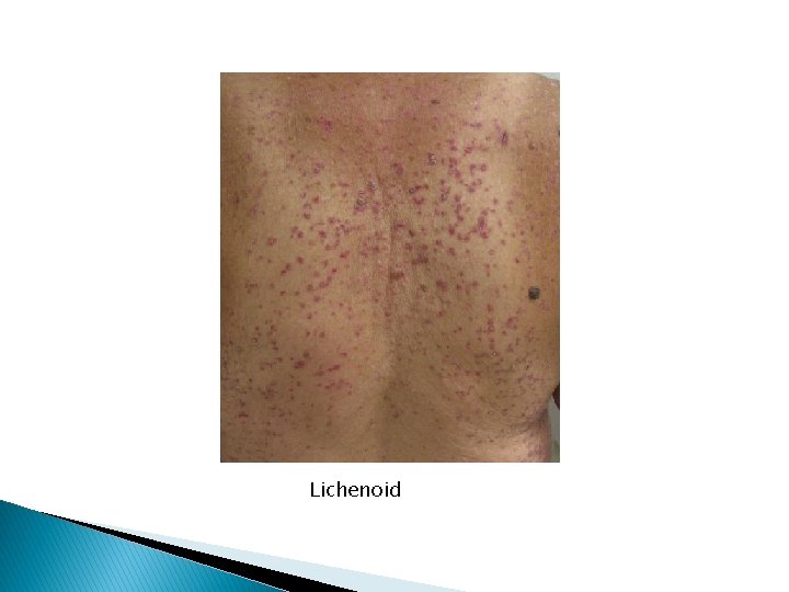 Lichenoid 