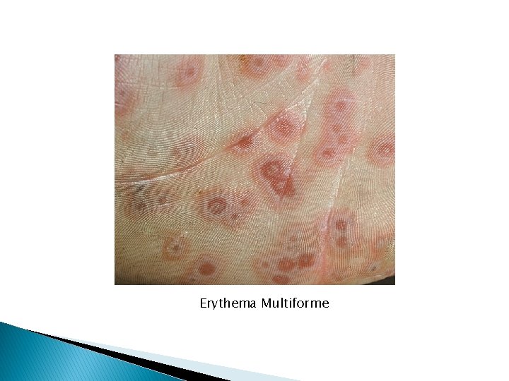 Erythema Multiforme 
