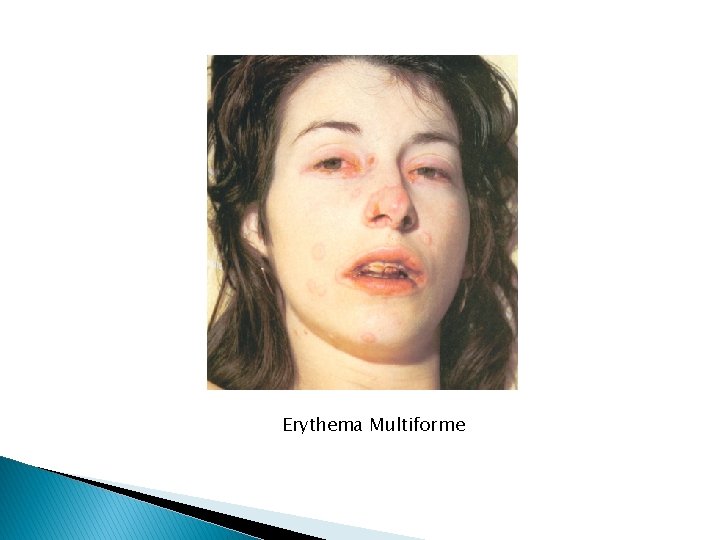 Erythema Multiforme 