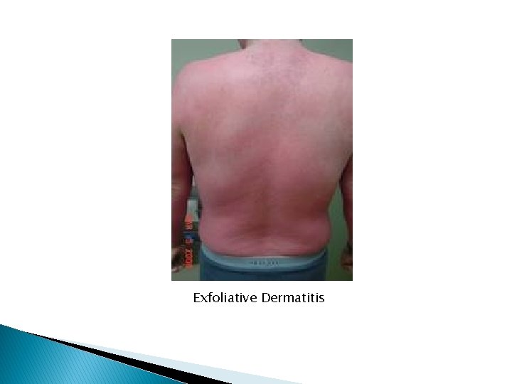Exfoliative Dermatitis 