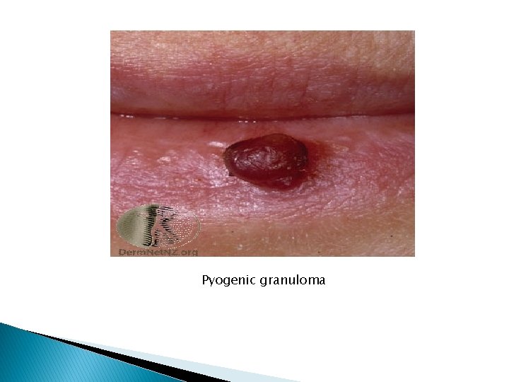 Pyogenic granuloma 