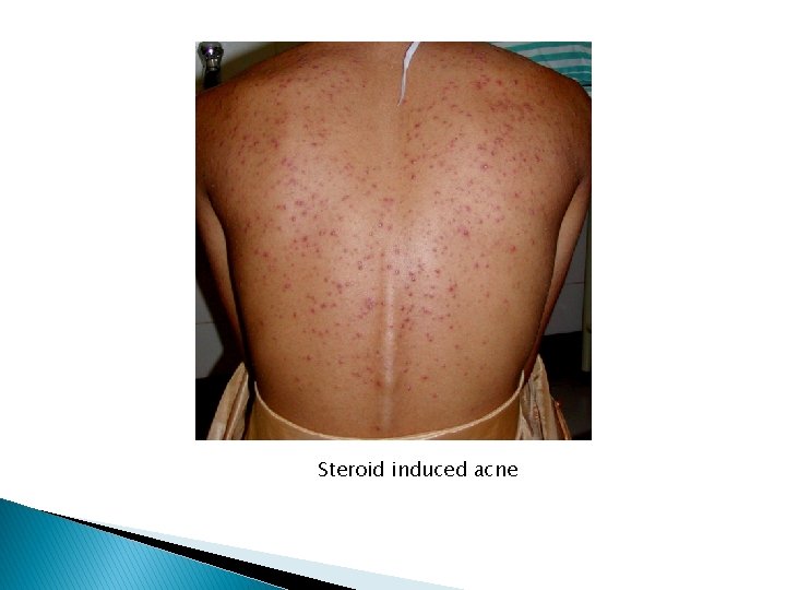 Steroid induced acne 