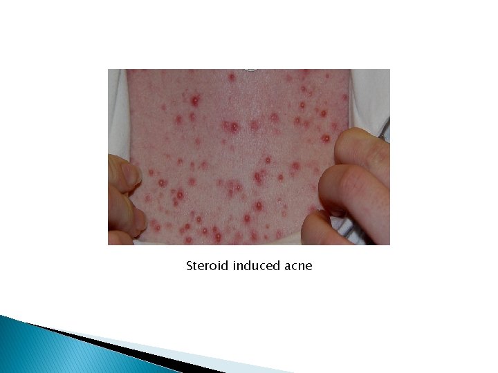 Steroid induced acne 