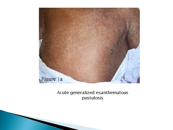 Acute generalized exanthematous pustulosis 