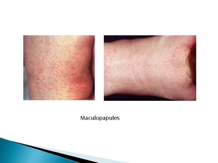 Maculopapules 