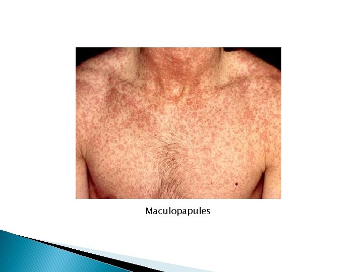 Maculopapules 