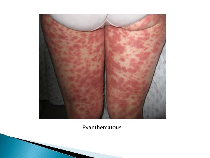 Exanthematous 