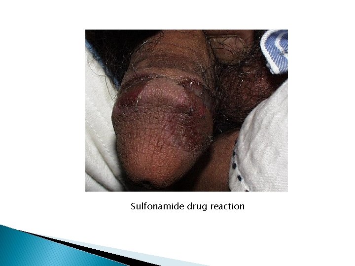 Sulfonamide drug reaction 