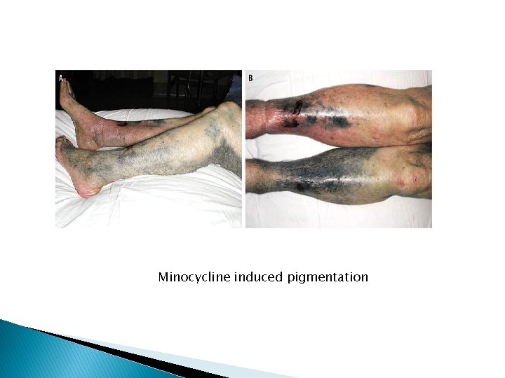 Minocycline induced pigmentation 