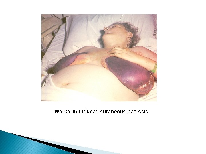 Warparin induced cutaneous necrosis 