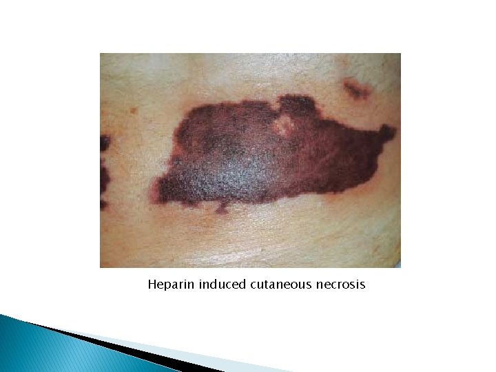 Heparin induced cutaneous necrosis 