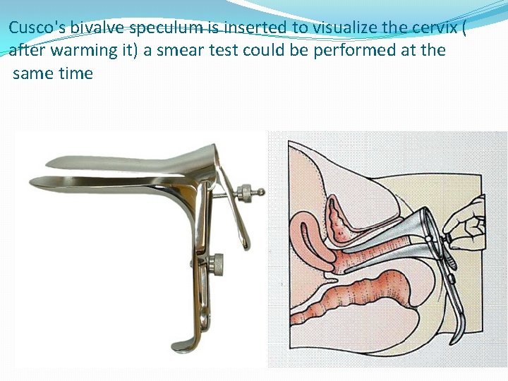 Cusco's bivalve speculum is inserted to visualize the cervix ( after warming it) a
