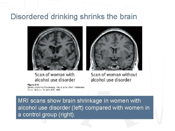 Disordered drinking shrinks the brain MRI scans show brain shrinkage in women with alcohol Disordered drinking shrinks the brain MRI scans show brain shrinkage in women with alcohol