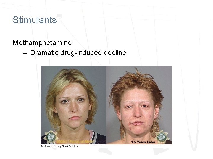 Stimulants Methamphetamine – Dramatic drug-induced decline Stimulants Methamphetamine – Dramatic drug-induced decline