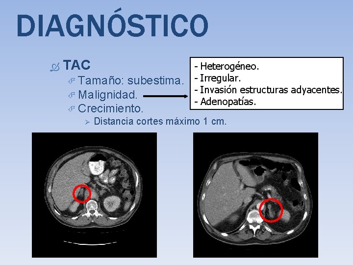 DIAGNÓSTICO TAC Tamaño: subestima. Malignidad. Crecimiento. Ø Heterogéneo. Irregular. Invasión estructuras adyacentes. Adenopatías. Distancia