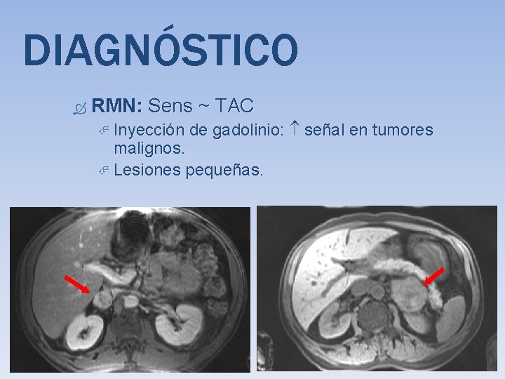 DIAGNÓSTICO RMN: Sens ~ TAC Inyección de gadolinio: señal en tumores malignos. Lesiones pequeñas.