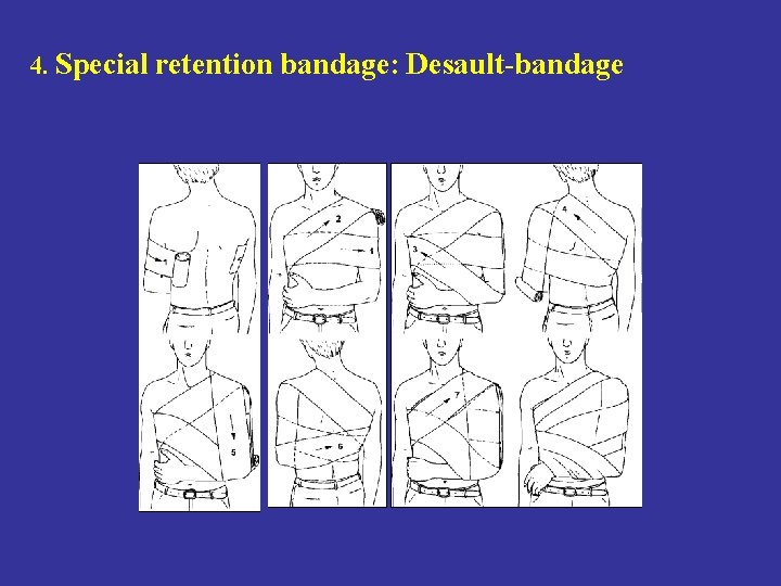 4. Special retention bandage: Desault-bandage 