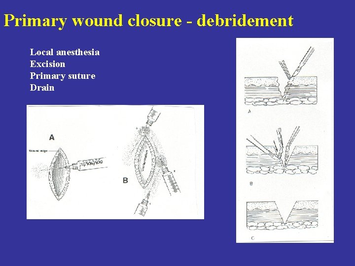 Primary wound closure - debridement Local anesthesia Excision Primary suture Drain 