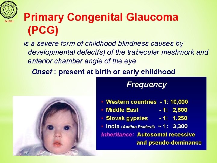 MIFBL Primary Congenital Glaucoma (PCG) is a severe form of childhood blindness causes by