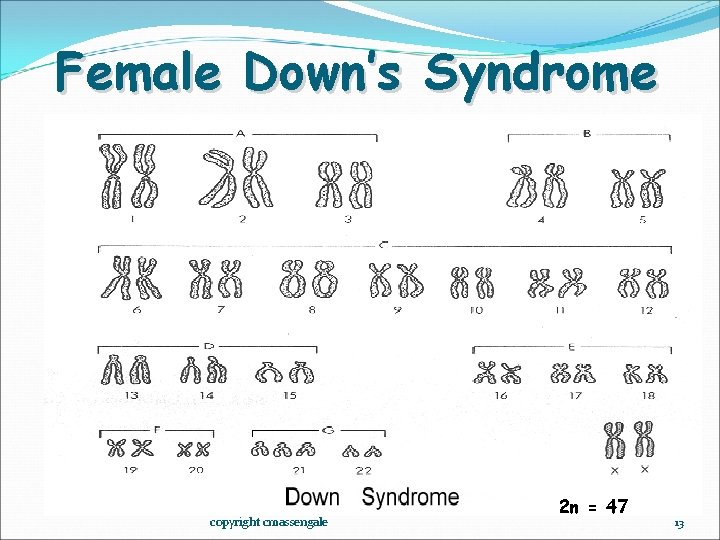 Female Down’s Syndrome copyright cmassengale 2 n = 47 13 
