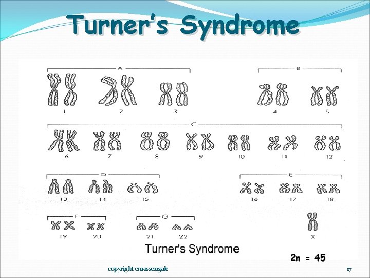 Turner’s Syndrome 2 n = 45 copyright cmassengale 17 