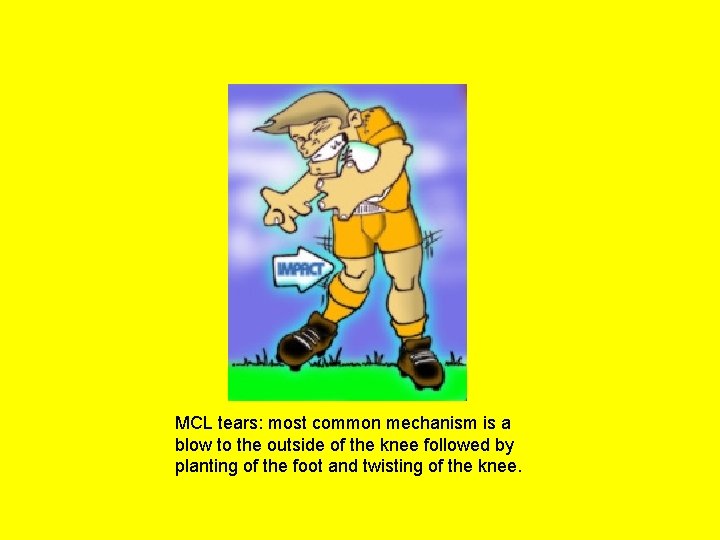 MCL tears: most common mechanism is a blow to the outside of the knee