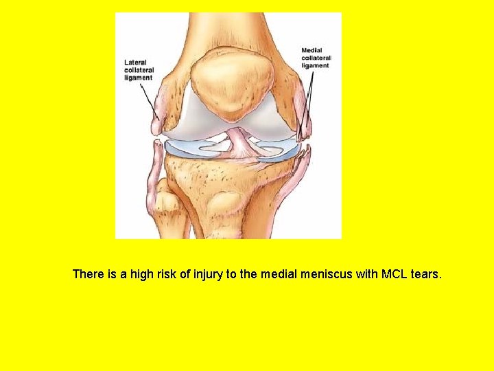 There is a high risk of injury to the medial meniscus with MCL tears.