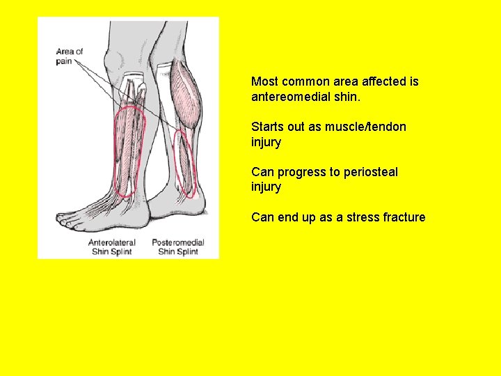 Most common area affected is antereomedial shin. Starts out as muscle/tendon injury Can progress