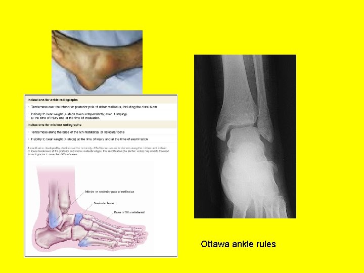Ottawa ankle rules 