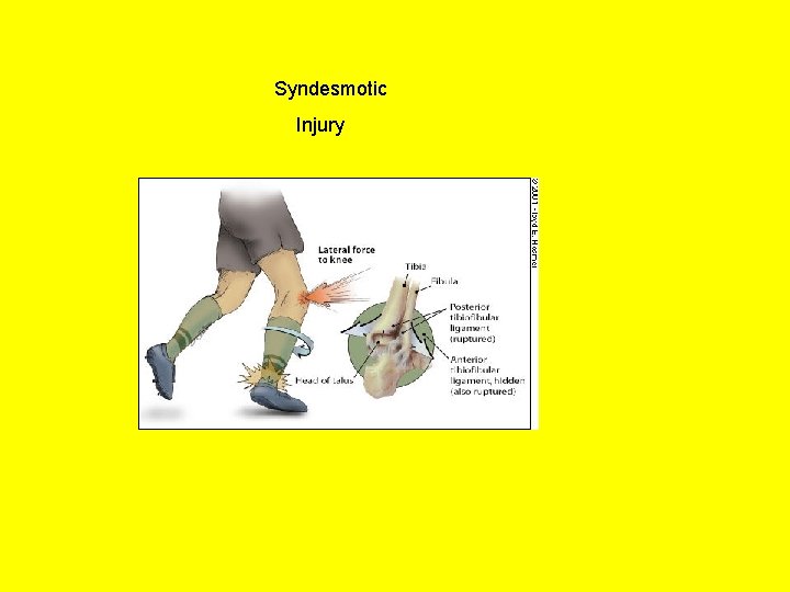 Syndesmotic Injury 