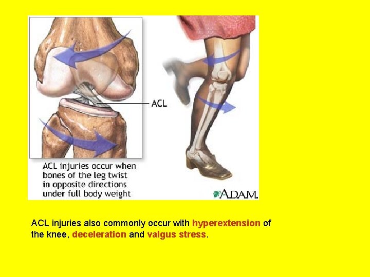 ACL injuries also commonly occur with hyperextension of the knee, deceleration and valgus stress.