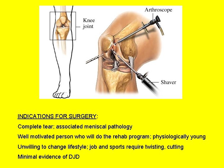INDICATIONS FOR SURGERY: Complete tear; associated meniscal pathology Well motivated person who will do