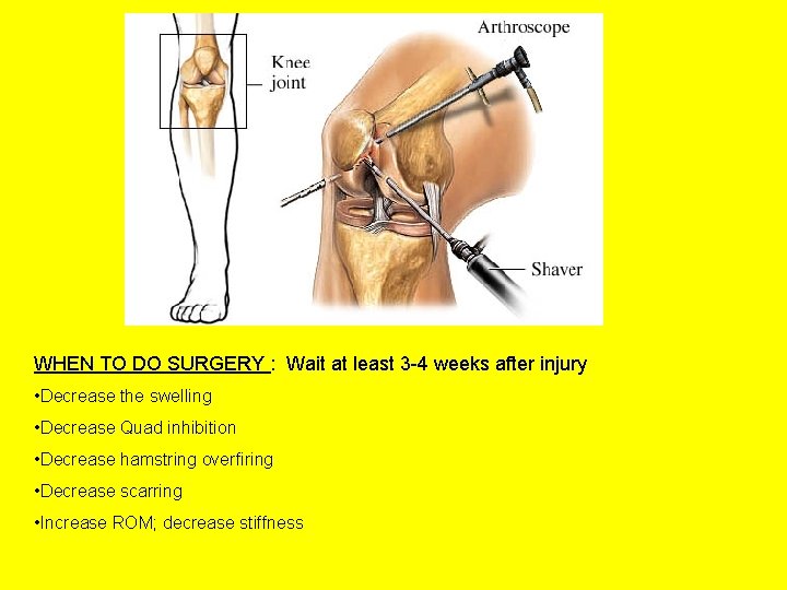 WHEN TO DO SURGERY : Wait at least 3 -4 weeks after injury •