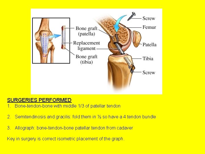 SURGERIES PERFORMED 1. Bone-tendon-bone with middle 1/3 of patellar tendon 2. Semitendinosis and gracilis: