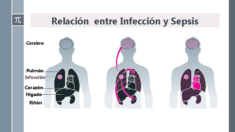 Relación entre Infección y Sepsis Cerebro Pulmón Infección Corazón Hígado Riñón 