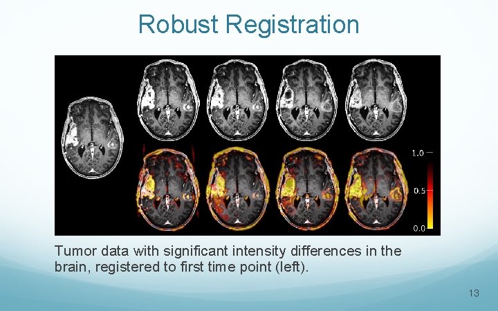 Robust Registration Tumor data with significant intensity differences in the brain, registered to first
