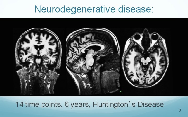 Neurodegenerative disease: 14 time points, 6 years, Huntington’s Disease 3 