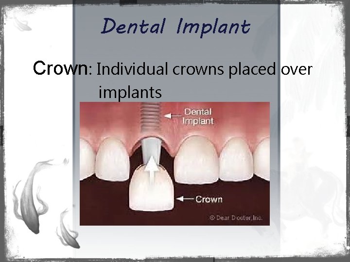 Dental Implant Crown: Individual crowns placed over implants 