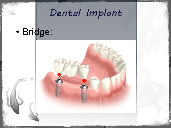 Dental Implant • Bridge: 