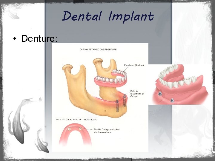 Dental Implant • Denture: 