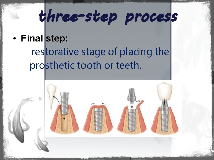 three-step process • Final step: restorative stage of placing the prosthetic tooth or teeth.