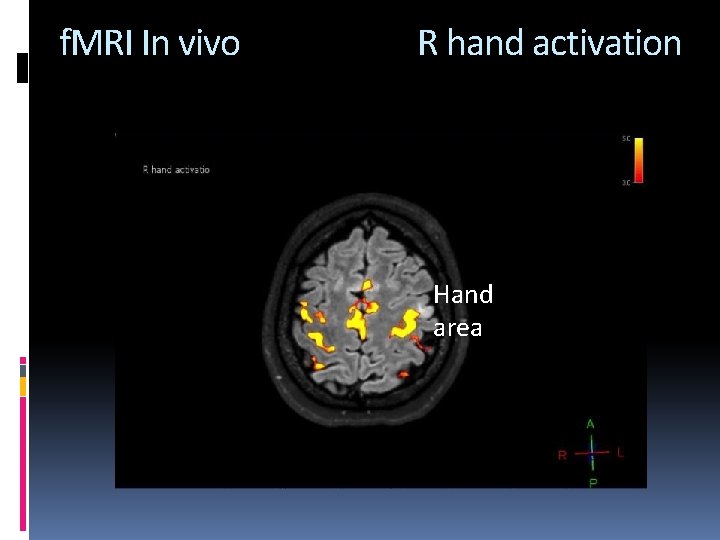 f. MRI In vivo R hand activation Hand area 