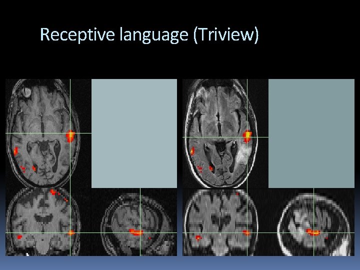 Receptive language (Triview) 